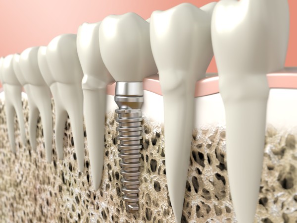 Dental Implants Your Best Option For Replacing Missing Teeth