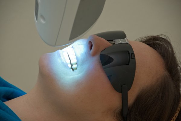 Professional Teeth Whitening Options From A General Dentist Office