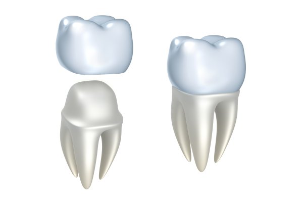 Signs Of Dental Implant Failure