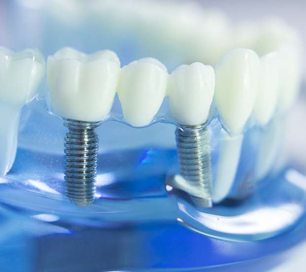 Lake Forest Dental Implants