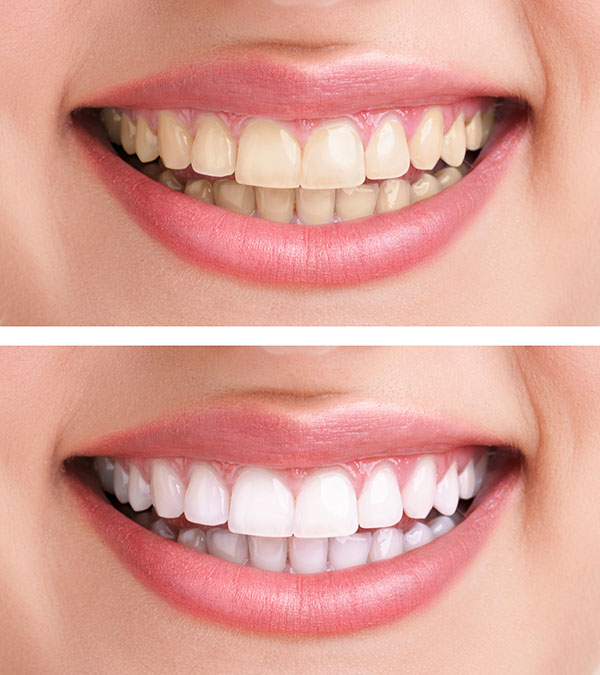 Learn About Professional Teeth Whitening Brands