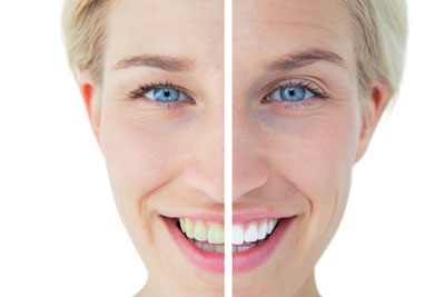 Teeth Whitening In Lake Forest To Get Beautiful Teeth